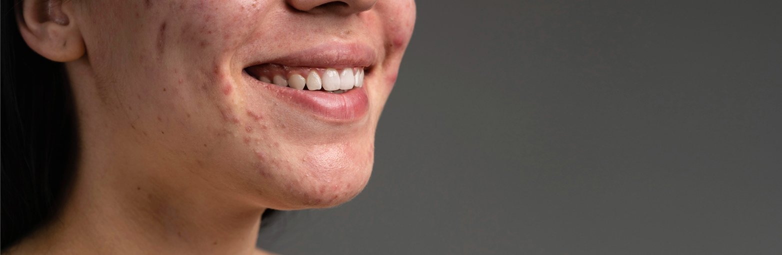 Acne & Excess Androgen